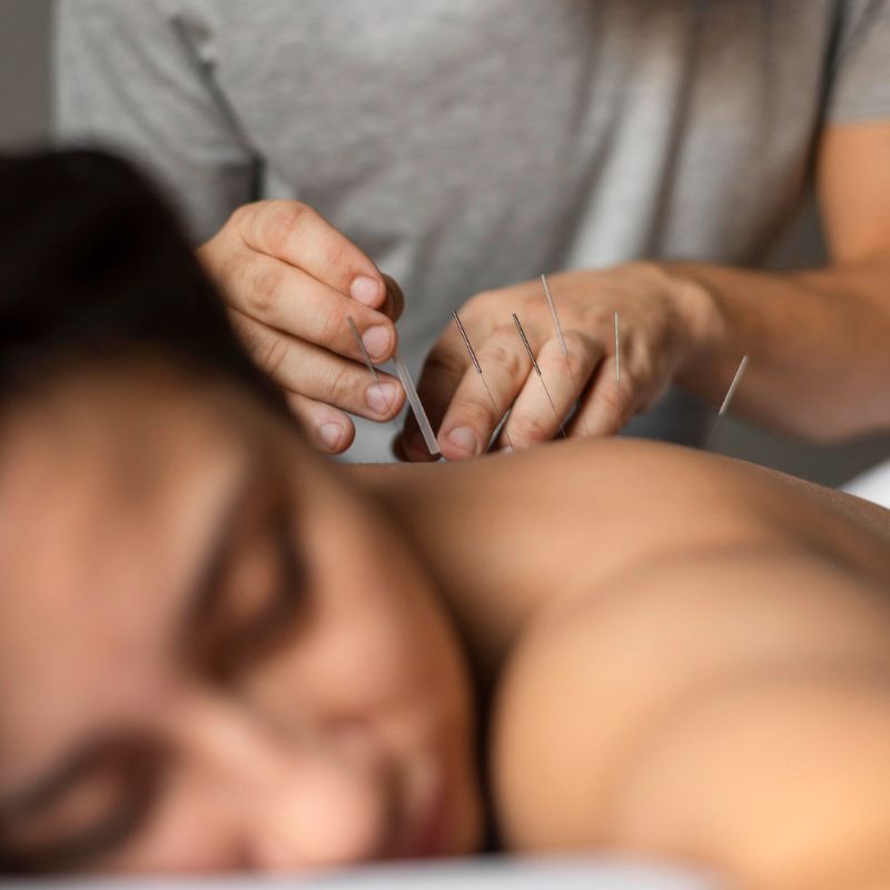 Acupuncture in Surrey BC